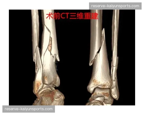 伊萨克脚踝骨折胫骨伤势 10场2球1助后提前告别本赛季